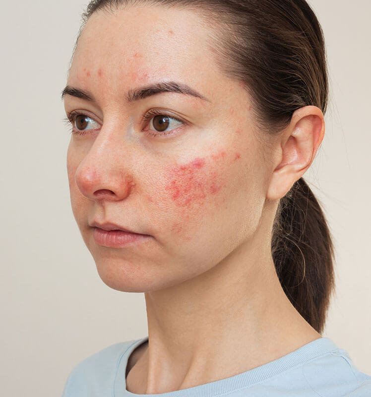 Before Face Treatment